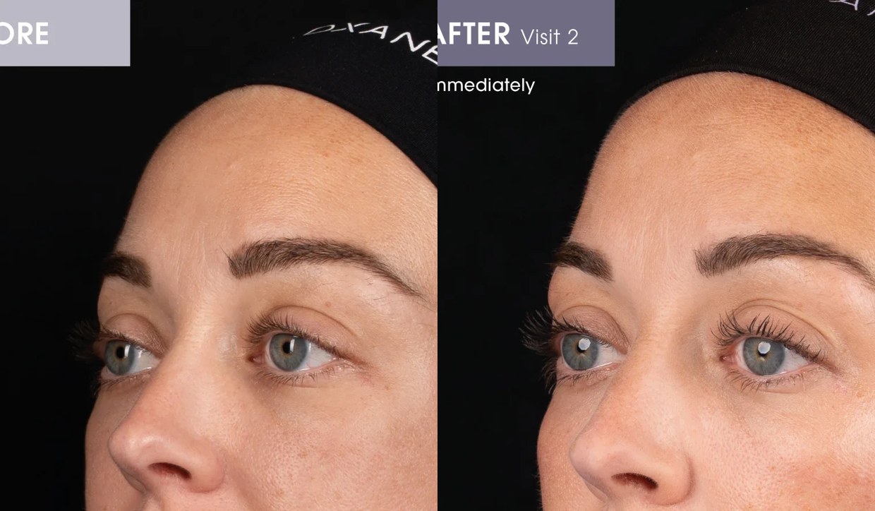 Before and after babyGLOW skin booster treatment result