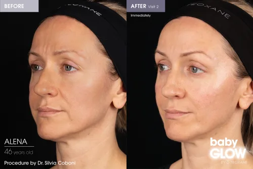 babyGLOW treatment at The Heath Clinic