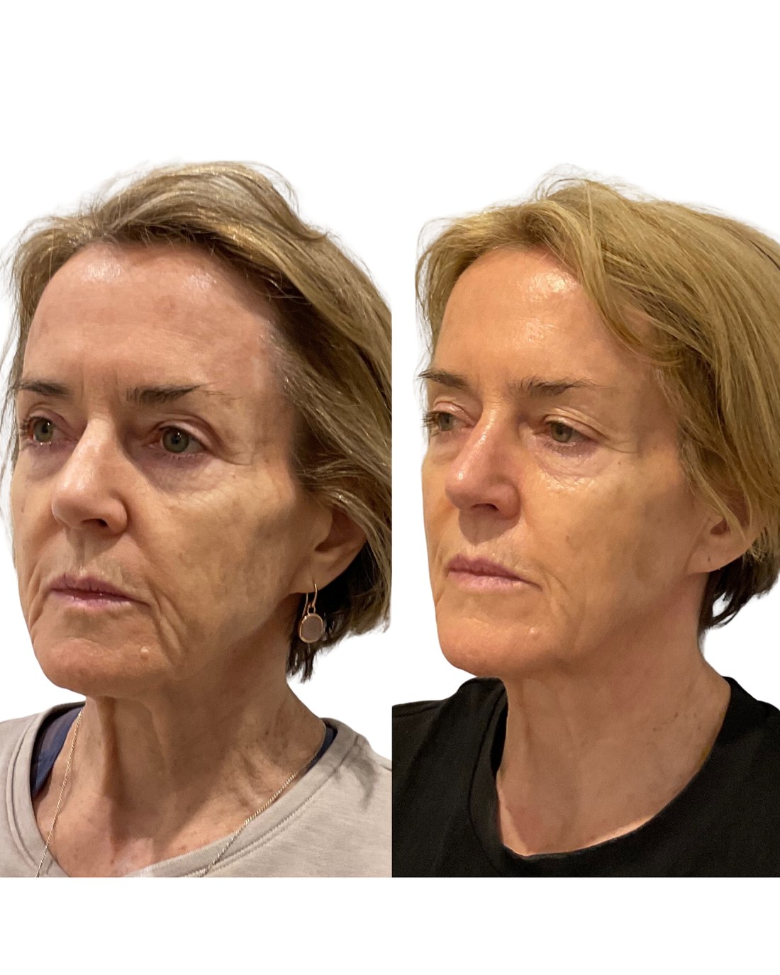 Before and after BBL treatment result