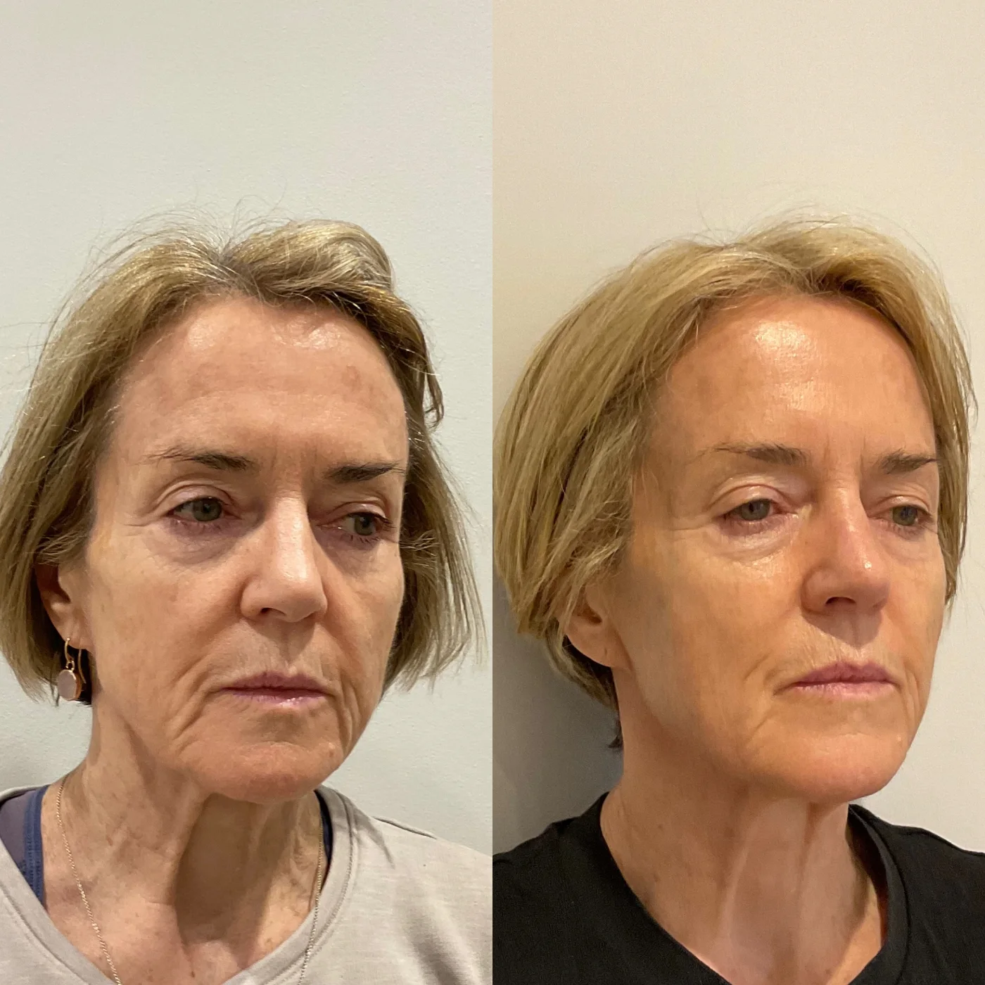 Before and after treatment result at The Heath Clinic
