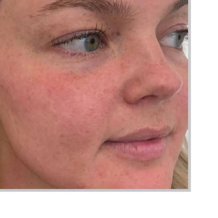 After Hydrafacial Treatment