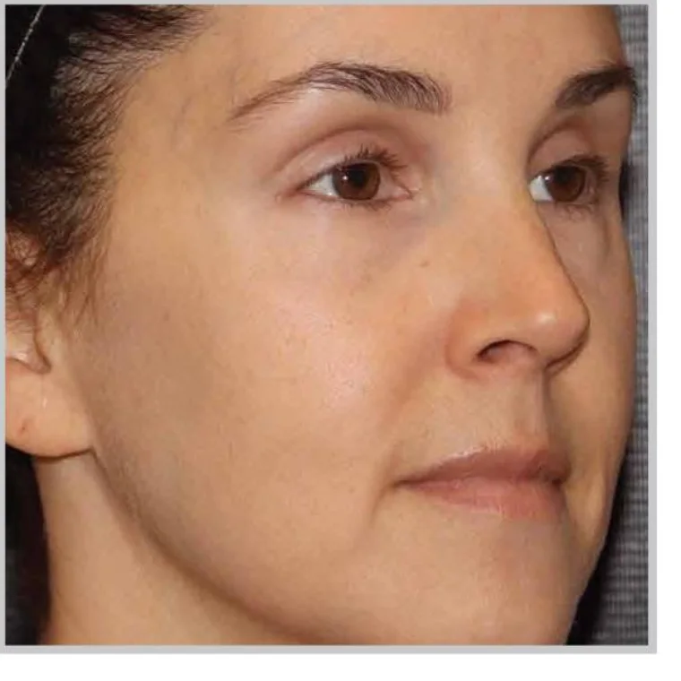Before Moxi laser treatment