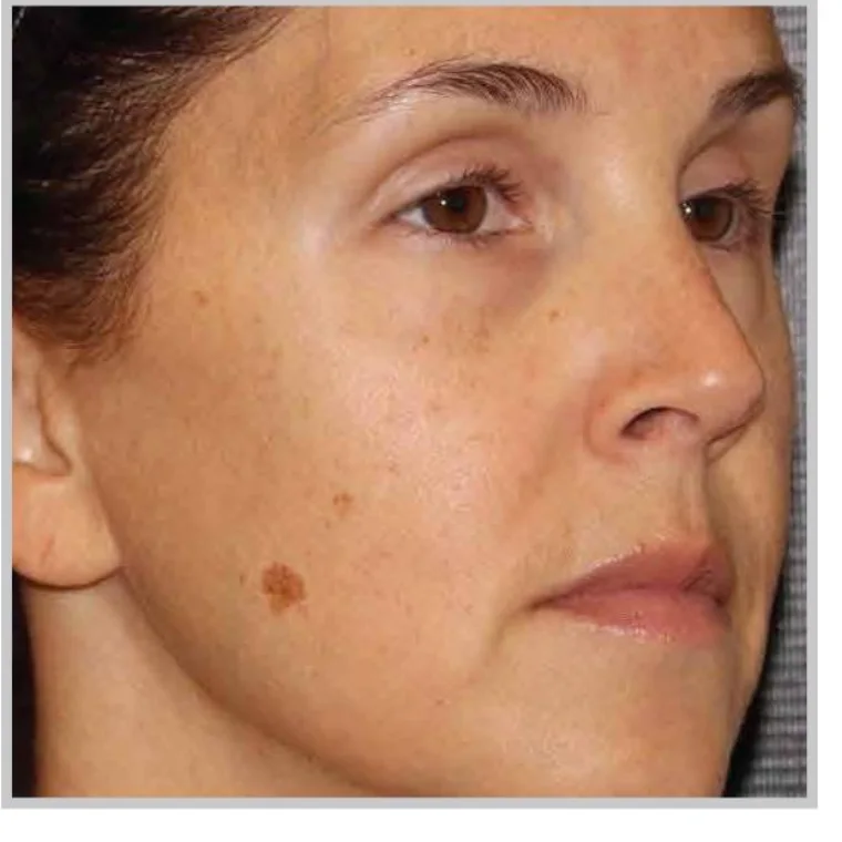 After Moxi laser treatment