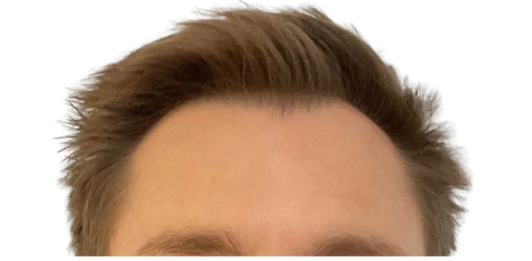 After Moxi laser treatment showing a clearer, more even forehead