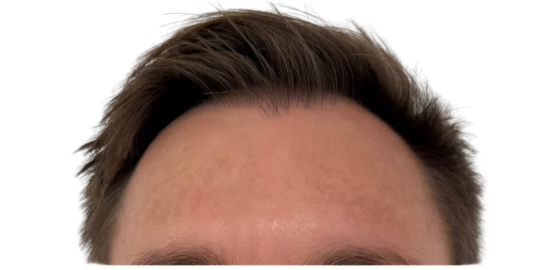 Before Moxi laser treatment showing forehead pigmentation